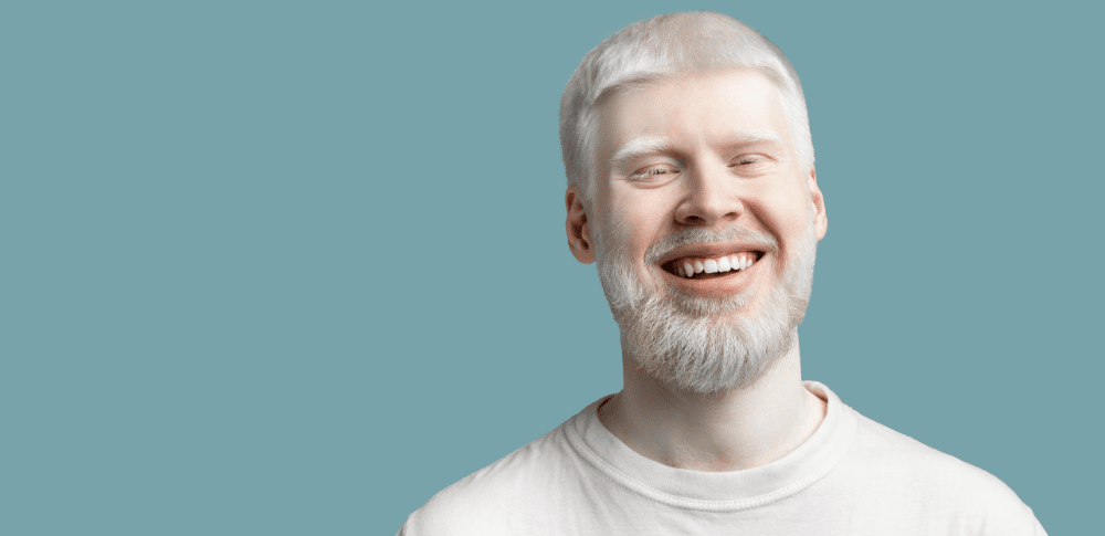 O que você precisa saber sobre o Albinismo